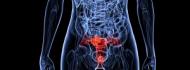 Uterine Cancer Treatment in Israel