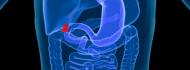 Gallbladder cancer treatment in Israel