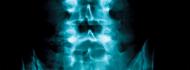 Scoliosis Treatment in Israel