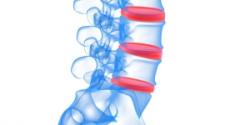 Herniated spinal disc