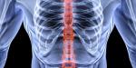Correction of the spine